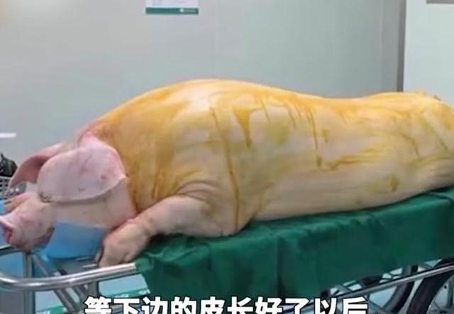 烧伤病人手术移植猪皮惹争议河南小伙全身96烧伤，医生现场杀猪移植皮肤