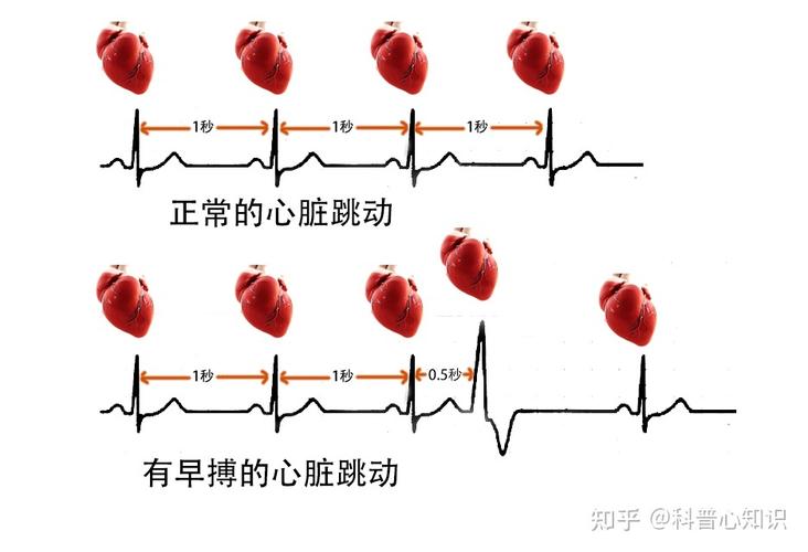 心脏早搏是怎么回事儿。 家电资讯