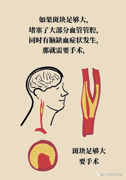 科普｜体检发现颈动脉斑块怎么办。
